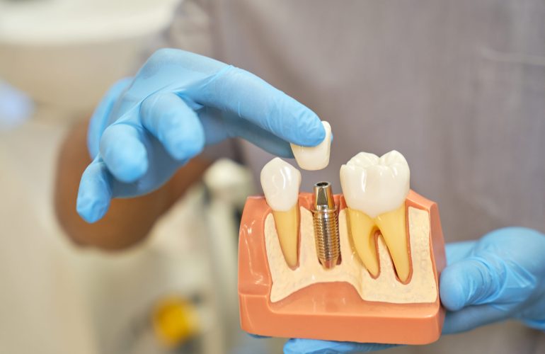 Close-up photo of principle of how dental implants work being demonstrated by a dental specialist